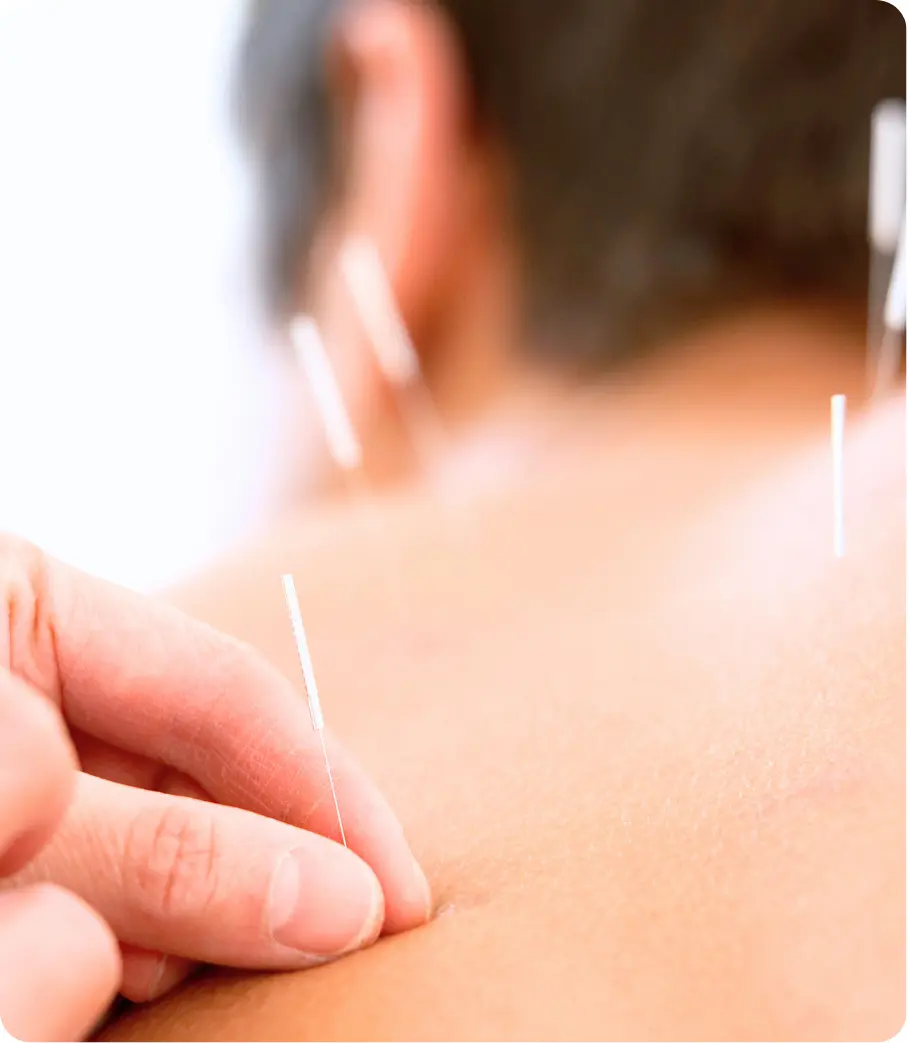 Acupuncture therapy session supporting stress relief and addiction recovery treatment